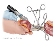 Orthopeadic surgery | Limb transplant