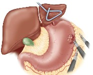 Laparoscopic | Gastric tumor resection