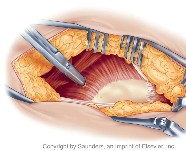 Hip surgery