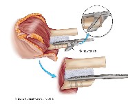 Orthopeadic surgery | Limb transplant