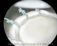 Shoulder arthoscopy | Plication sutures placed