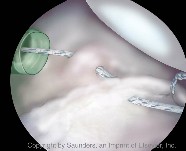 Shoulder arthoscopy | Suture shuttled under labrum and through capsule