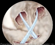 Knee arthoscopy | Sutures in PL and AM tunnels