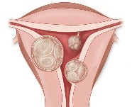 Gynecology | Fibroid locations