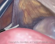 Laparoscopic | Abdominal exposure