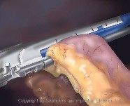 Laparoscopic | Bowel resection
