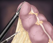 Laparoscopic | Mobilizing large intestine