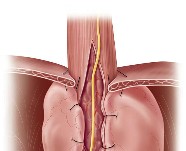 Laparoscopic | Myotomy