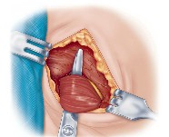 Adductor longus muscle isolation