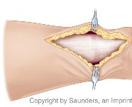 Approach to achilles rupture
