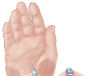 Carpal tunnel