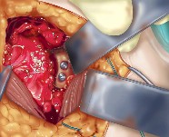 Coracoid graft secured to glenoid rim