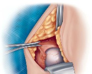 Femoral head in acetabulum