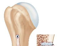 Interference screw in humerus