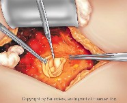 Internal bladder wall exposure