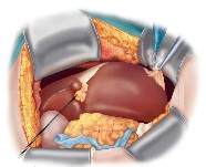 Liver surgery