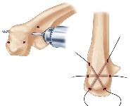 Olecranon drill sites