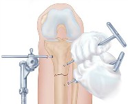 Shantz pin placement