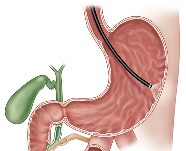 Transillumination on abdominal wall